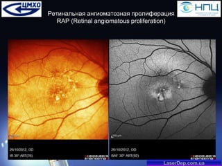Ретинальная ангиоматозная пролиферация
RAP (Retinal angiomatous proliferation)

LaserDep.com.ua

 
