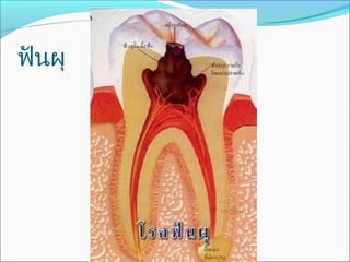 ฟันผุ
 