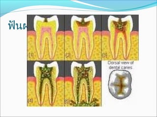 ฟันผุ
 