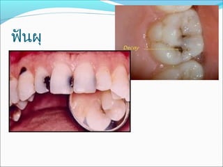 ฟันผุ
 