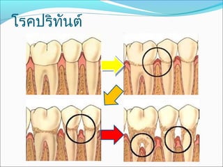 โรคปริทันต์
 
