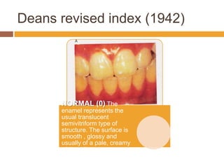 Deans revised index (1942)

NORMAL (0) The
enamel represents the
usual translucent
semivitriform type of
structure. The surface is
smooth , glossy and
usually of a pale, creamy
white colour.

 