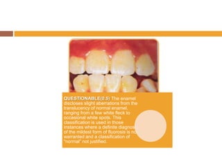 QUESTIONABLE(0.5) The enamel
discloses slight aberrations from the
translucency of normal enamel,
ranging from a few white fleck to
occasional white spots. This
classification is used in those
instances where a definite diagnosis
of the mildest form of fluorosis is not
warranted and a classification of
“normal” not justified.

 
