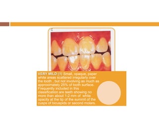 VERY MILD (1) Small, opaque, paper
white areas scattered irregularly over
the tooth , but not involving as much as
approximately 25% of tooth surface.
Frequently included in this
classification are teeth showing no
more than about 1-2 mm of white
opacity at the tip of the summit of the
cusps of bicuspids or second molars.

 