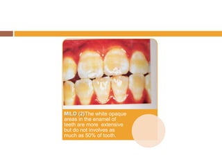 MILD (2)The white opaque
areas in the enamel of
teeth are more extensive
but do not involves as
much as 50% of tooth.

 