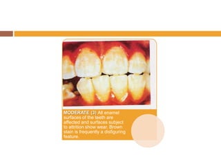 MODERATE (3) All enamel
surfaces of the teeth are
affected and surfaces subject
to attrition show wear. Brown
stain is frequently a disfiguring
feature.

 
