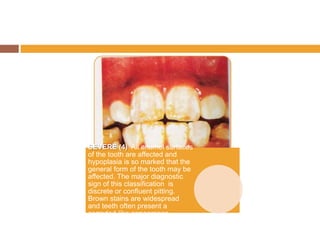 SEVERE (4) All enamel surfaces
of the tooth are affected and
hypoplasia is so marked that the
general form of the tooth may be
affected. The major diagnostic
sign of this classification is
discrete or confluent pitting.
Brown stains are widespread
and teeth often present a
corroded-like appearance.

 