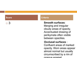 Score


3

Criteria

Smooth surfaces:
Merging and irregular
cloudy areas of opacity.
Accentuated drawing of
perikymata often visible
between opacities.
Occlusal surfaces :
Confluent areas of marked
opacity. Worn areas appear
almost normal but usually
circumscribed by a rim of

 