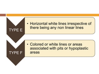 TYPE E

TYPE F

• Horizontal white lines irrespective of
there being any non linear lines

• Colored or white lines or areas
associated with pits or hypoplastic
areas

 