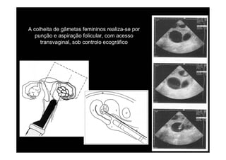 A colheita de gâmetas femininos realiza-se por
   punção e aspiração folicular, com acesso
     transvaginal, sob controlo ecográfico
 