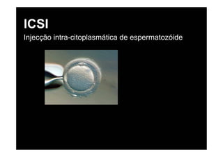 ICSI
Injecção intra-citoplasmática de espermatozóide
 