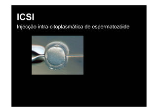 ICSI
Injecção intra-citoplasmática de espermatozóide
 