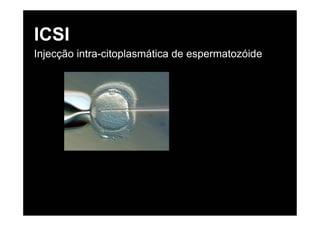 ICSI
Injecção intra-citoplasmática de espermatozóide
 
