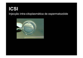 ICSI
Injecção intra-citoplasmática de espermatozóide
 