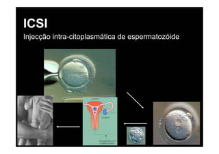 ICSI
Injecção intra-citoplasmática de espermatozóide
 