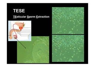 TESE
TEsticular Sperm Extraction
 
