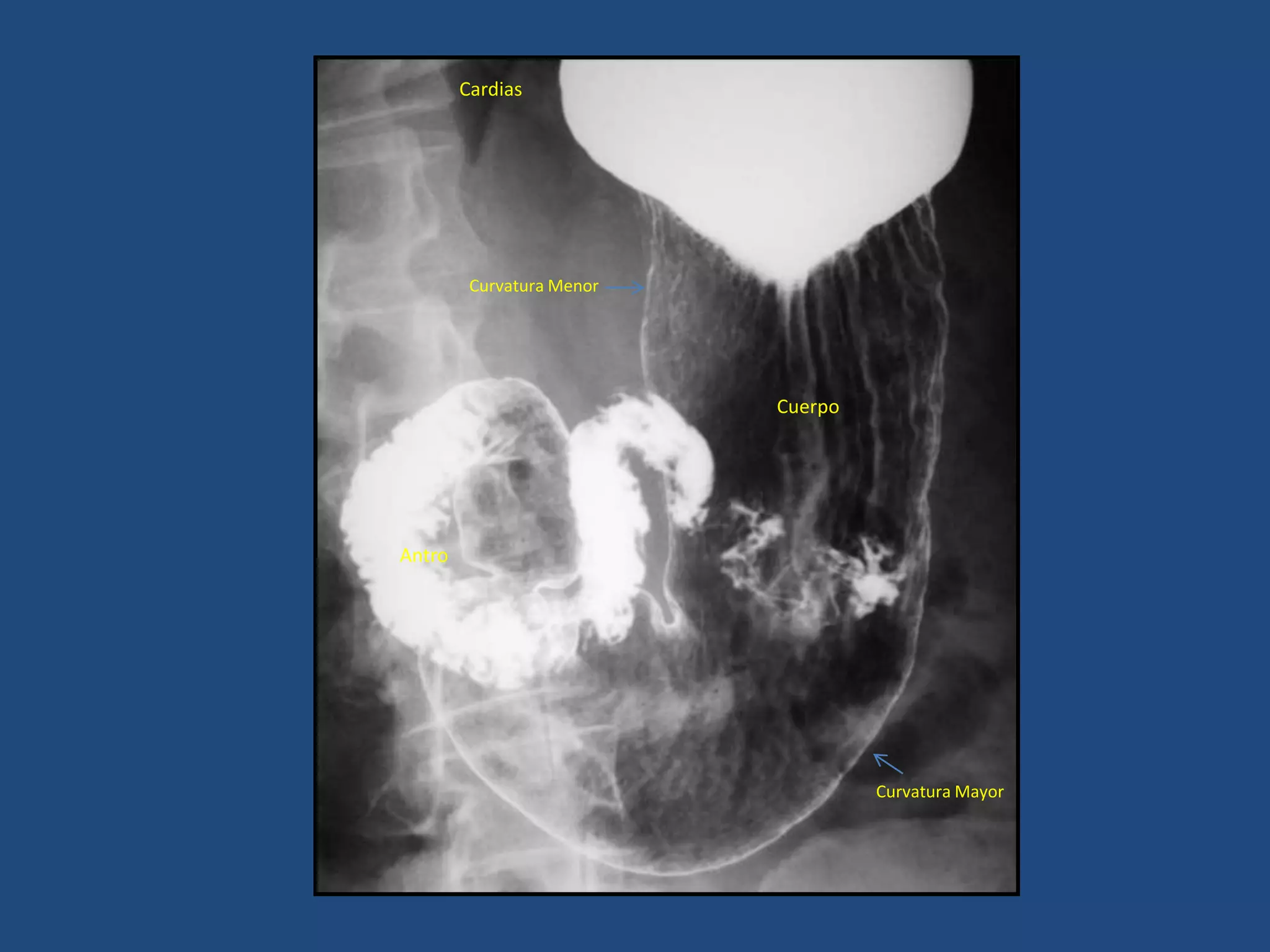 Cuerpo
Antro
Curvatura Menor
Curvatura Mayor
Cardias
 