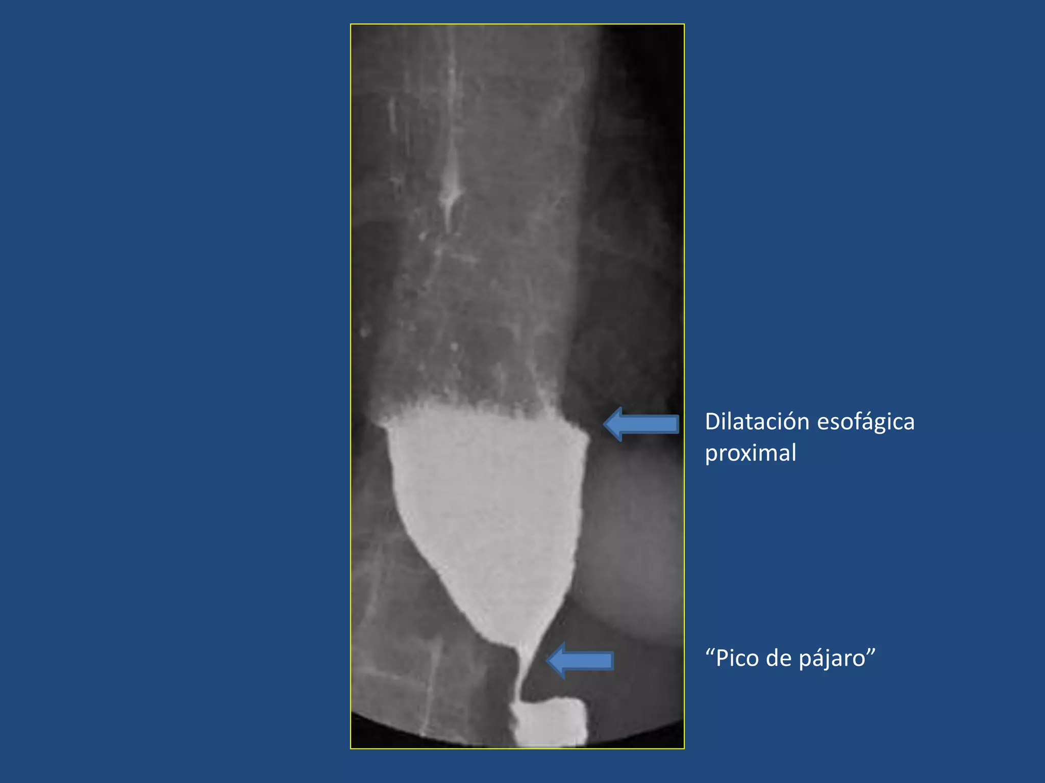Dilatación esofágica
proximal
“Pico de pájaro”
 