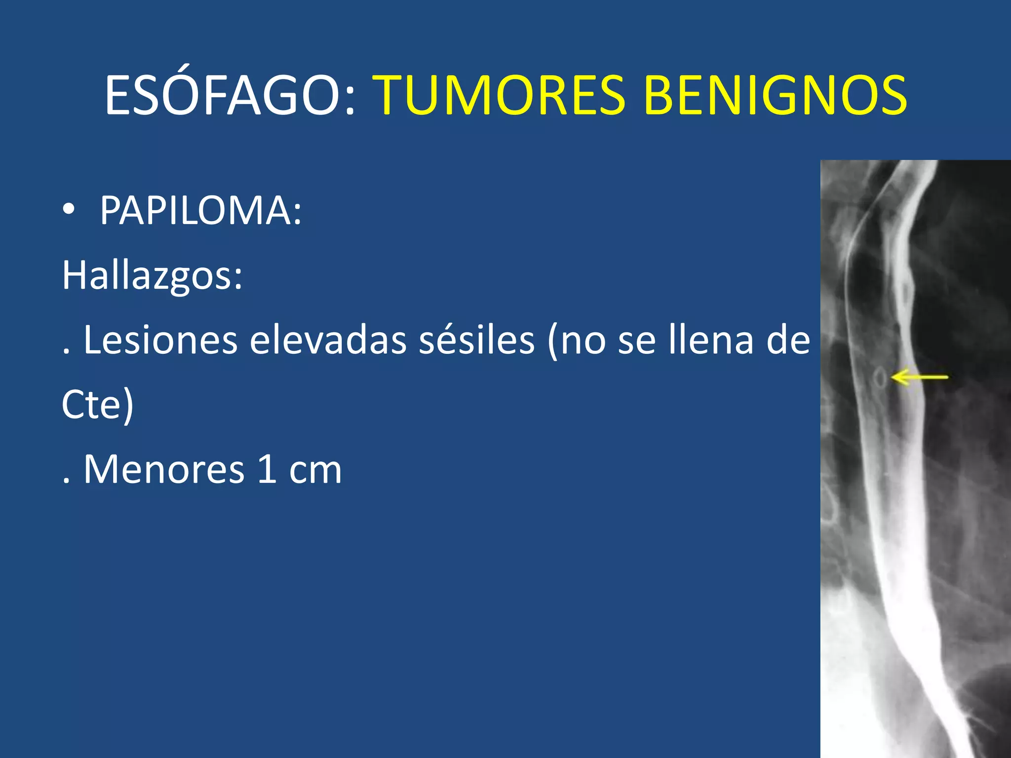 ESÓFAGO: TUMORES BENIGNOS
• PAPILOMA:
Hallazgos:
. Lesiones elevadas sésiles (no se llena de
Cte)
. Menores 1 cm
 