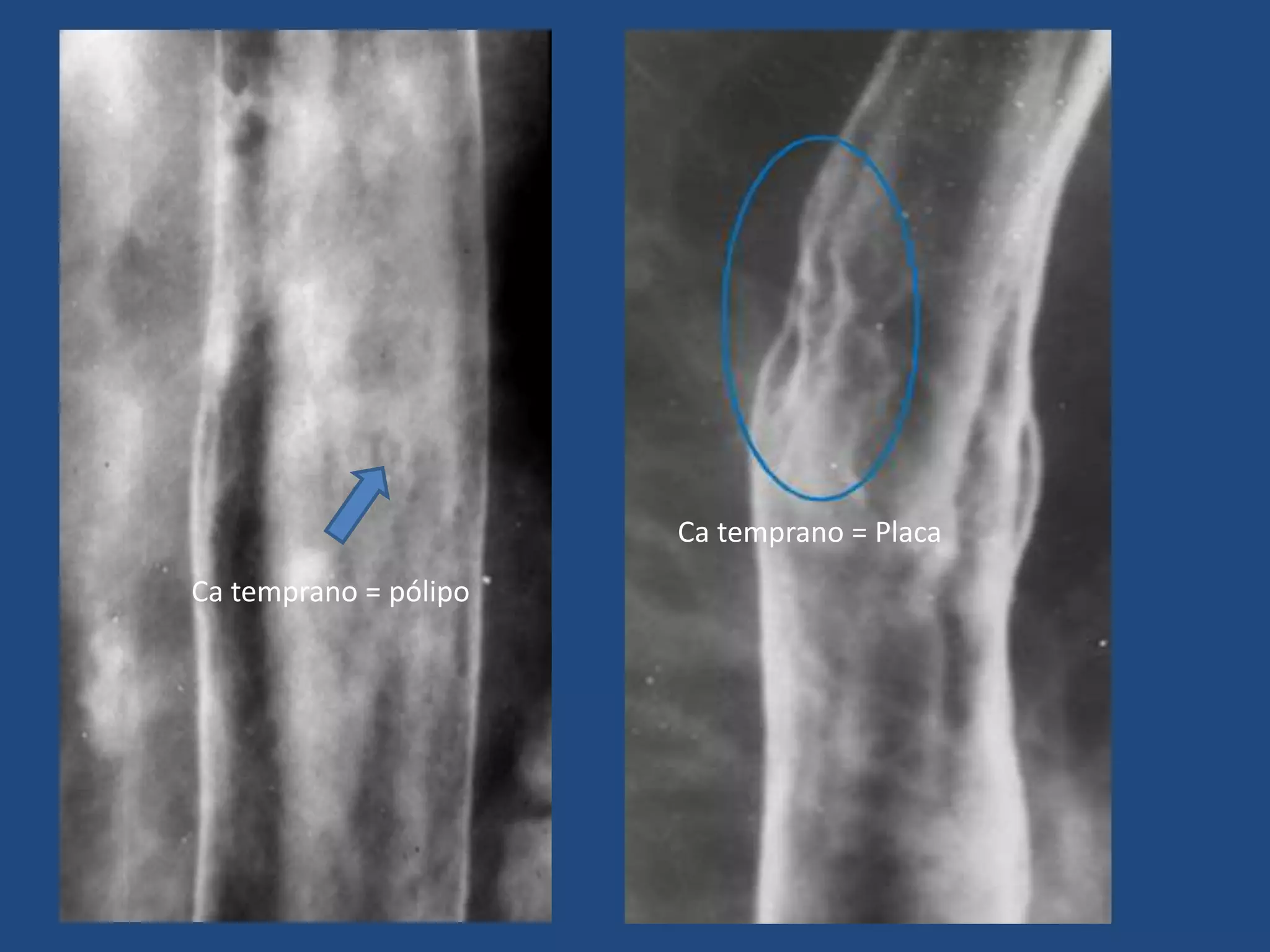 Ca temprano = pólipo
Ca temprano = Placa
 
