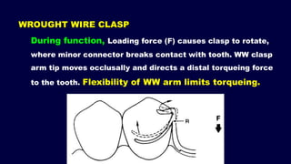 Wrought Wire Rpd 2- a. Basic principles for designing the removable partial denture ...