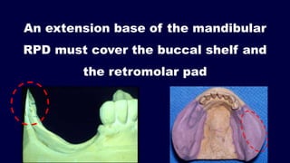 2- a. Basic principles for designing the removable partial denture ...