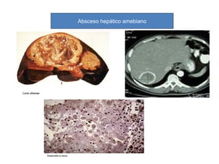 Absceso hepático amebiano
 