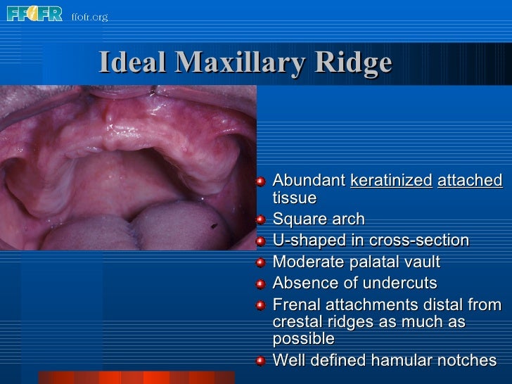 Tissue Ridges 2.anatomy of the denture foundation areas