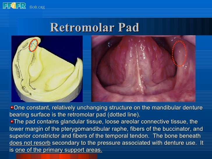 2.anatomy of the denture foundation areas