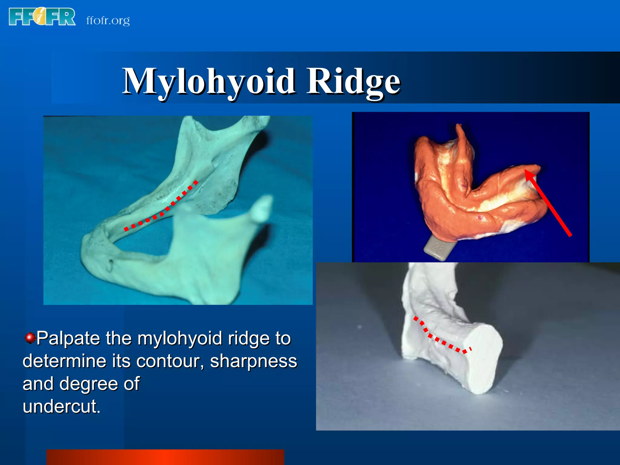 2.anatomy of the denture foundation areas | PPT