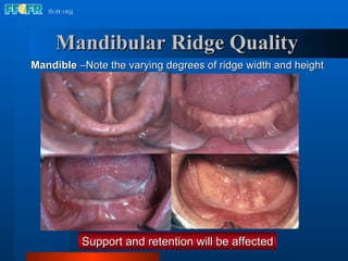 2.anatomy of the denture foundation areas | PPT