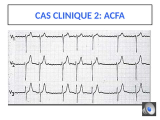 CAS CLINIQUE 2: ACFA
 