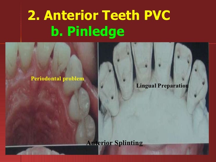 2. artificial crowns partial veneer crowns midterm2