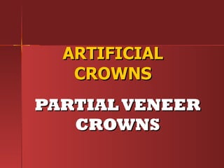 ARTIFICIAL CROWNS PARTIAL VENEER CROWNS 