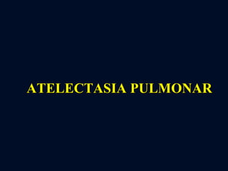 ATELECTASIA PULMONAR 