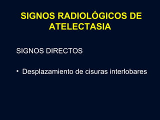 SIGNOS RADIOLÓGICOS DE ATELECTASIA SIGNOS DIRECTOS Desplazamiento de cisuras interlobares 
