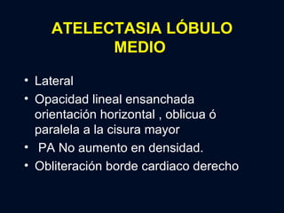 ATELECTASIA LÓBULO MEDIO <ul><li>Lateral </li></ul><ul><li>Opacidad lineal ensanchada orientación horizontal , oblicua ó  ...