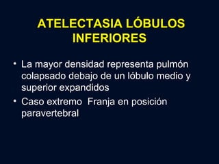 ATELECTASIA LÓBULOS INFERIORES La mayor densidad representa pulmón colapsado debajo de un lóbulo medio y superior expandidos Caso extremo  Franja en posición paravertebral 