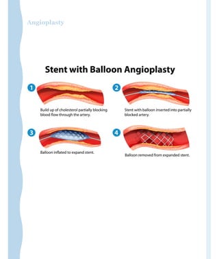 Angioplasty
 