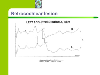Retrocochlear lesion 