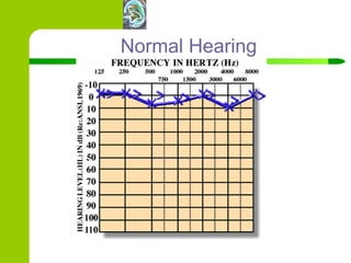 Normal Hearing 