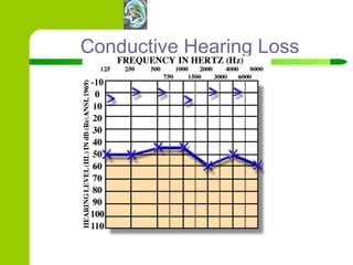 Conductive Hearing Loss 