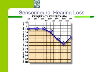 Sensorineural Hearing Loss 