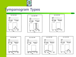 Tympanogram Types 