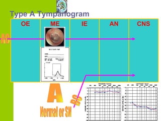 Type A Tympanogram A Normal or SN BC OE ME IE AN CNS AC 