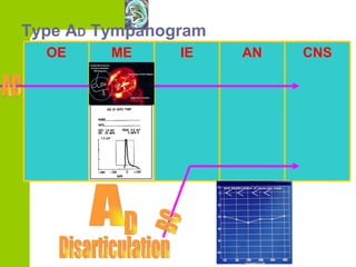 Type A D  Tympanogram BC Disarticulation OE ME IE AN CNS AC A D 