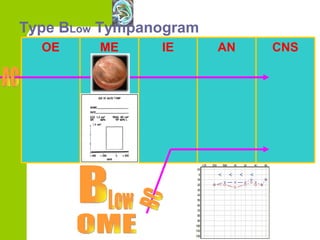 Type B Low  Tympanogram BC OME OE ME IE AN CNS AC B Low 