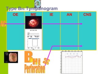 Type B Hi  Tympanogram BC Perforation OE ME IE AN CNS AC B Hi 