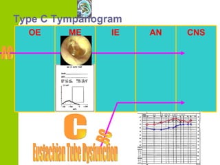 Type C Tympanogram BC Eustachian Tube Dysfunction C OE ME IE AN CNS AC 