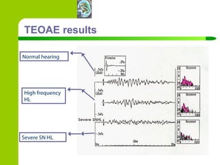 TEOAE results Severe SN HL Normal hearing High frequency HL 